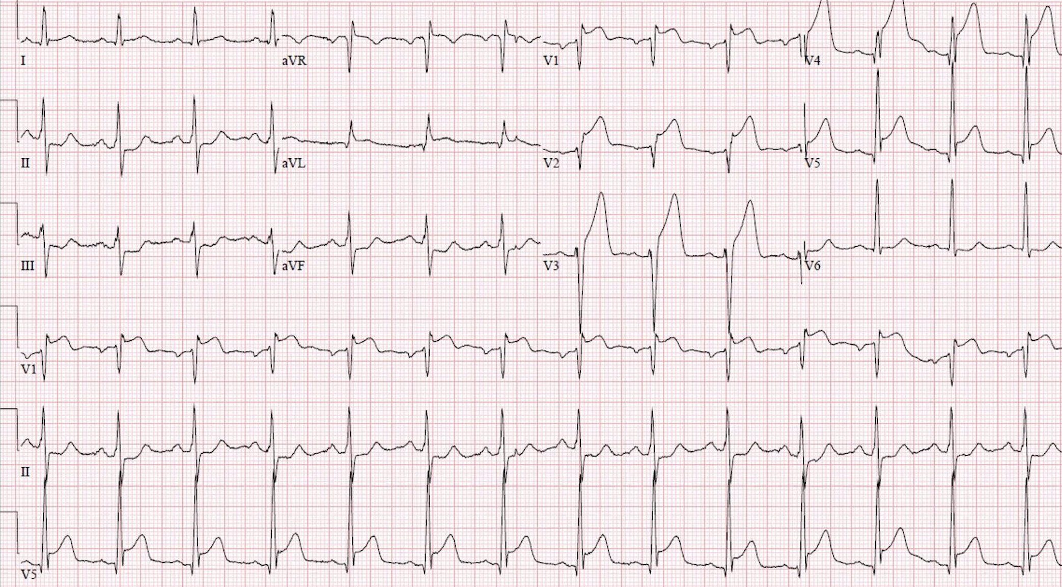 12-Kanal-EKG mit ST-Hebungen bei Vorderwand-STEMI